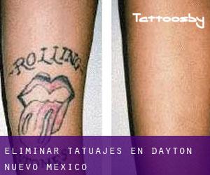 Eliminar tatuajes en Dayton (Nuevo México)