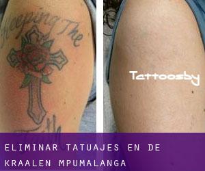 Eliminar tatuajes en De Kraalen (Mpumalanga)