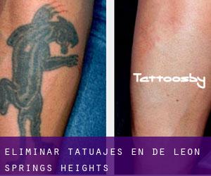 Eliminar tatuajes en De Leon Springs Heights