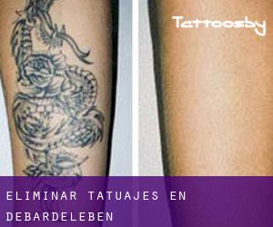 Eliminar tatuajes en Debardeleben