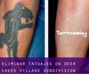 Eliminar tatuajes en Deer Creek Village Subdivision