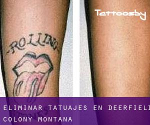 Eliminar tatuajes en Deerfield Colony (Montana)
