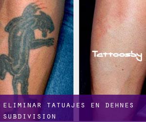 Eliminar tatuajes en Dehne's Subdivision