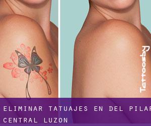 Eliminar tatuajes en Del Pilar (Central Luzon)