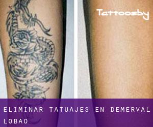 Eliminar tatuajes en Demerval Lobão
