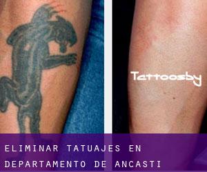 Eliminar tatuajes en Departamento de Ancasti