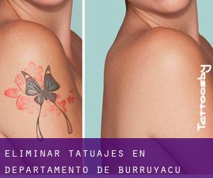 Eliminar tatuajes en Departamento de Burruyacú