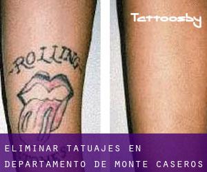 Eliminar tatuajes en Departamento de Monte Caseros