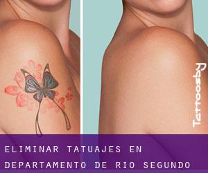Eliminar tatuajes en Departamento de Río Segundo