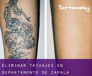 Eliminar tatuajes en Departamento de Zapala