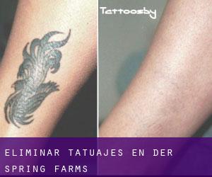 Eliminar tatuajes en Der Spring Farms