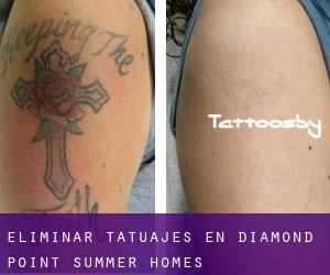 Eliminar tatuajes en Diamond Point Summer Homes