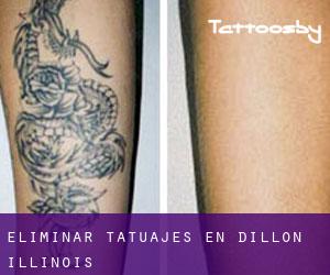 Eliminar tatuajes en Dillon (Illinois)