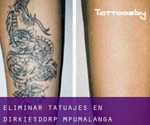 Eliminar tatuajes en Dirkiesdorp (Mpumalanga)