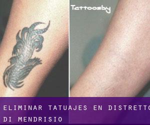 Eliminar tatuajes en Distretto di Mendrisio