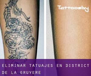 Eliminar tatuajes en District de la Gruyère