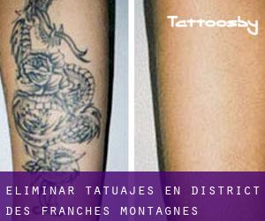 Eliminar tatuajes en District des Franches-Montagnes