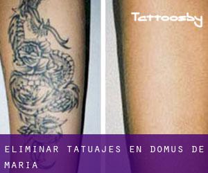 Eliminar tatuajes en Domus de Maria