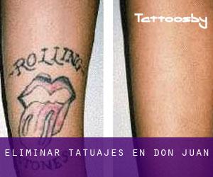 Eliminar tatuajes en Don Juan