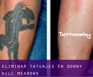 Eliminar tatuajes en Donny Hill Meadows