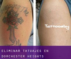 Eliminar tatuajes en Dorchester Heights (Massachusetts)