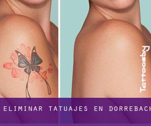 Eliminar tatuajes en Dörrebach