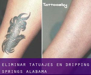 Eliminar tatuajes en Dripping Springs (Alabama)