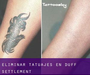 Eliminar tatuajes en Duff Settlement