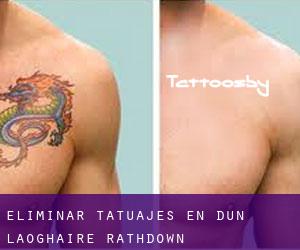 Eliminar tatuajes en Dún Laoghaire-Rathdown