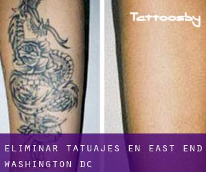 Eliminar tatuajes en East End (Washington, D.C.)