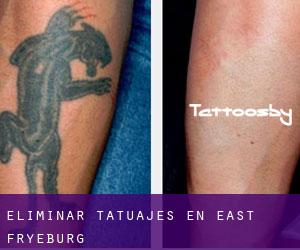 Eliminar tatuajes en East Fryeburg