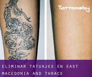 Eliminar tatuajes en East Macedonia and Thrace