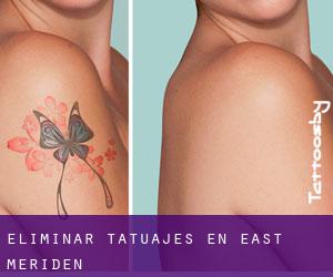Eliminar tatuajes en East Meriden
