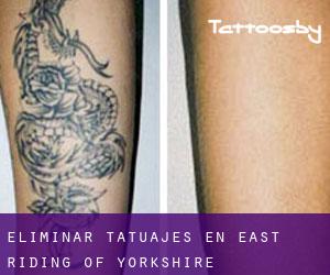 Eliminar tatuajes en East Riding of Yorkshire