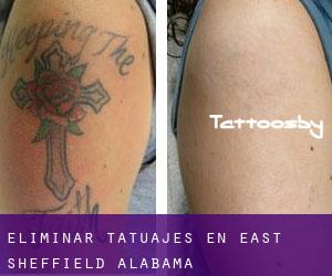 Eliminar tatuajes en East Sheffield (Alabama)