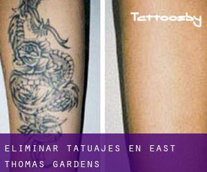 Eliminar tatuajes en East Thomas Gardens