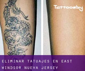 Eliminar tatuajes en East Windsor (Nueva Jersey)