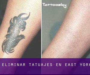 Eliminar tatuajes en East York