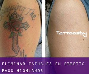 Eliminar tatuajes en Ebbetts Pass Highlands