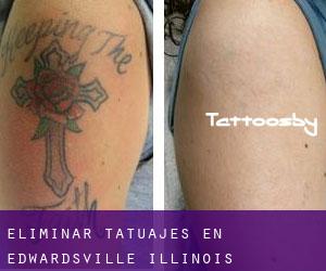 Eliminar tatuajes en Edwardsville (Illinois)