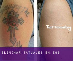 Eliminar tatuajes en Egg