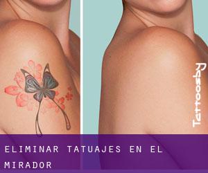 Eliminar tatuajes en El Mirador