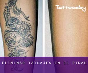 Eliminar tatuajes en El Pinal