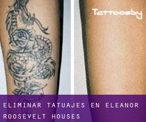 Eliminar tatuajes en Eleanor Roosevelt Houses