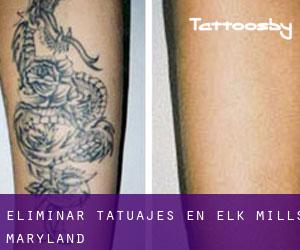 Eliminar tatuajes en Elk Mills (Maryland)