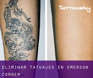 Eliminar tatuajes en Emerson Corner