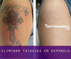 Eliminar tatuajes en Espanola