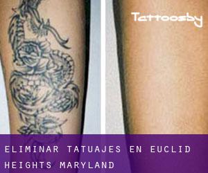 Eliminar tatuajes en Euclid Heights (Maryland)