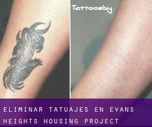 Eliminar tatuajes en Evans Heights Housing Project