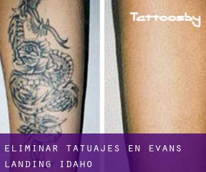 Eliminar tatuajes en Evans Landing (Idaho)